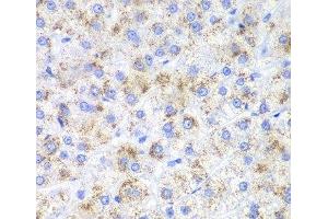 Immunohistochemistry of paraffin-embedded Human liver cancer using HAO1 Polyclonal Antibody at dilution of 1:200 (40x lens). (HAO1 抗体)
