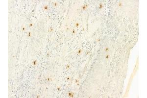 ABIN6261092 and ABIN6277988 at 1/100 staining human cervical carcinoma by IHC-P. (CTNNBL1 抗体  (N-Term))