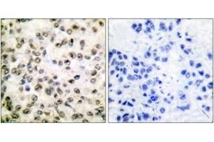 Immunohistochemistry analysis of paraffin-embedded human breast carcinoma tissue, using CREB-BP Antibody. (CBP 抗体  (AA 2393-2442))