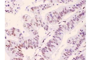 PML Protein was detected in paraffin-embedded sections of human intetsinal cancer tissues using rabbit anti- PML Protein Antigen Affinity purified polyclonal antibody (Catalog # ) at 1 ? (PML 抗体  (N-Term))