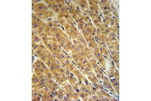 CP Antibody (Center) (ABIN391513 and ABIN2841474) IHC analysis in formalin fixed and paraffin embedded human hepatocarcinoma followed by peroxidase conjugation of the secondary antibody and DAB staining. (Ceruloplasmin 抗体  (Center))