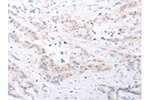 The image on the left is immunohistochemistry of paraffin-embedded Human colon cancer tissue using ABIN7131156(SPATA16 Antibody) at dilution 1/25, on the right is treated with fusion protein. (SPATA16 抗体)