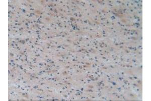 IHC-P analysis of Human Glioma Tissue, with DAB staining. (APOA2 抗体  (AA 24-100))