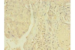 Immunohistochemistry of paraffin-embedded human lung cancer using ABIN7172152 at dilution of 1:100 (THRB 抗体  (AA 1-461))