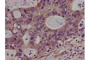Immunohistochemistry of paraffin-embedded human colon cancer using ABIN7169080 at dilution of 1:100 (PKN2 抗体  (AA 925-969))