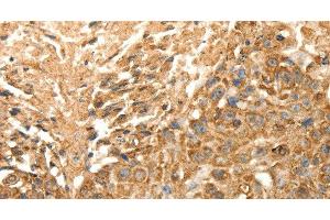 Immunohistochemistry of paraffin-embedded Human esophagus cancer using SLC25A11 Polyclonal Antibody at dilution of 1:30 (SLC25A11 抗体)