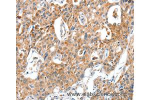 Immunohistochemistry of Human lung cancer using BAX Polyclonal Antibody at dilution of 1:30 (BAX 抗体)