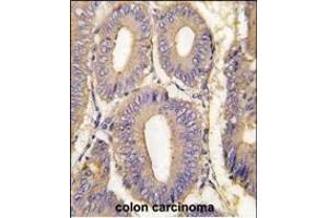 Formalin-fixed and raffin-embedded human colon carcinoma tissue reacted with K1 Antibody  (ABIN392432 and ABIN2842032) , which was peroxidase-conjugated to the secondary antibody, followed by DAB staining. (PAK1 抗体  (AA 401-430))
