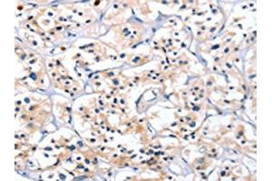 The image on the left is immunohistochemistry of paraffin-embedded Human thyroid cancer tissue using ABIN7128792(CATSPER1 Antibody) at dilution 1/40, on the right is treated with fusion protein. (CATSPER1 抗体)