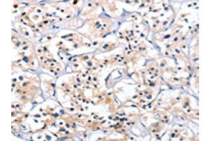 The image on the left is immunohistochemistry of paraffin-embedded Human thyroid cancer tissue using ABIN7128792(CATSPER1 Antibody) at dilution 1/40, on the right is treated with fusion protein.