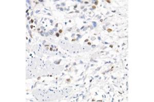 Immunohistochemistry of paraffin-embedded human esophageal cancer using Survivin Rabbit pAb (ABIN6132229, ABIN6137562, ABIN6137563 and ABIN6218613) at dilution of 1:100 (40x lens).