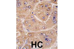 Formalin-fixed and paraffin-embedded human hepatocellular carcinoma reacted with FUCA2 polyclonal antibody  , which was peroxidase-conjugated to the secondary antibody, followed by DAB staining. (FUCA2 抗体  (N-Term))