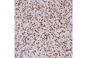 Immunohistochemical staining (Formalin-fixed paraffin-embedded sections) of human glioma with ATRX monoclonal antibody, clone CL0537  shows strong nuclear positivity in tumor cells. (ATRX 抗体)
