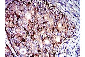 Immunohistochemical analysis of paraffin-embedded cervical cancer tissues using CD107b mouse mAb with DAB staining. (LAMP2 抗体  (AA 29-168))