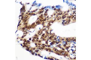 Immunohistochemistry of paraffin-embedded Human colon carcinoma using RBM15 Rabbit pAb (ABIN1682491, ABIN3019286, ABIN3019287, ABIN5664924 and ABIN6220805) at dilution of 1:100 (40x lens).