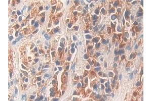Detection of KLK11 in Human Prostate cancer Tissue using Polyclonal Antibody to Kallikrein 11 (KLK11) (Kallikrein 11 抗体  (AA 39-282))
