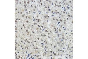 Immunohistochemistry of paraffin-embedded human liver cancer using BRAP Rabbit pAb (ABIN7265922) at dilution of 1:100 (40x lens). (BRAP 抗体  (AA 1-200))