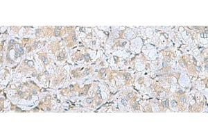 Immunohistochemistry of paraffin-embedded Human liver cancer tissue using BDNF Polyclonal Antibody at dilution of 1:65(x200) (BDNF 抗体)
