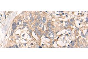 Immunohistochemistry of paraffin-embedded Human lung cancer tissue using NREP Polyclonal Antibody at dilution of 1:35(x200) (NREP 抗体)