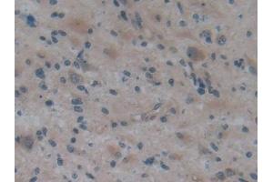 Detection of APOA2 in Human Glioma Tissue using Polyclonal Antibody to Apolipoprotein A2 (APOA2) (APOA2 抗体  (AA 24-100))