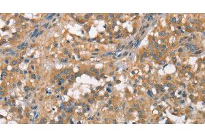 Immunohistochemistry of paraffin-embedded Human thyroid cancer using PLEKHO1 Polyclonal Antibody at dilution of 1:70 (PLEKHO1 抗体)