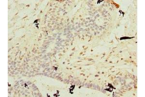 Immunohistochemistry of paraffin-embedded human breast cancer using ABIN7174699 at dilution of 1:100 (AKNA Domain Containing 1 (AKNAD1) (AA 1-223) 抗体)