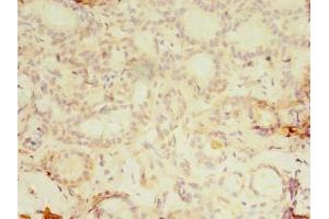 Immunohistochemistry of paraffin-embedded human breast cancer using ABIN7157249 at dilution of 1:100 (KBTBD4 抗体  (AA 151-415))