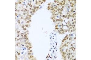 Immunohistochemistry of paraffin-embedded human lung cancer using HDAC1 antibody. (HDAC1 抗体  (AA 393-482))