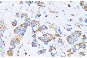 Immunohistochemistry of paraffin-embedded Human breast cancer using CA13 Polyclonal Antibody at dilution of 1:100 (40x lens). (CA13 抗体)