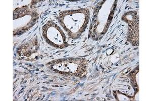 Immunohistochemical staining of paraffin-embedded Adenocarcinoma of colon tissue using anti-TPMT mouse monoclonal antibody. (TPMT 抗体)