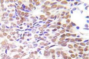 Immunohistochemistry (IHC)analyzes of HDAC1 antibody in paraffin-embedded human lung adenocarcinoma tissue. (HDAC1 抗体)
