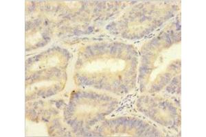 Immunohistochemistry of paraffin-embedded human endometrial cancer using ABIN7166030 at dilution of 1:100 (S1A1 (AA 2-94) 抗体)