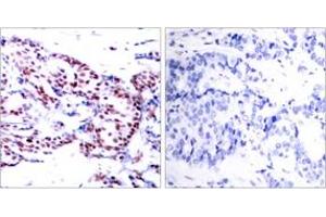 Immunohistochemistry analysis of paraffin-embedded human breast carcinoma tissue, using ATF2 (Ab-71 or 53) Antibody. (ATF2 抗体  (AA 38-87))
