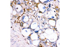 Anti- GPX1 antibody, IHC(P) IHC(P): Human Intestinal Cancer Tissue (Glutathione Peroxidase 1 抗体  (Middle Region))