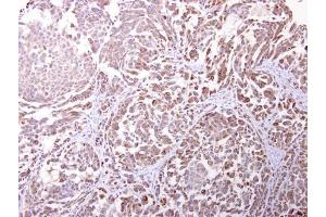 IHC-P Image Endomucin antibody [N1C2] detects Endomucin protein at cytosol on human lung carcinoma by immunohistochemical analysis. (Endomucin 抗体)
