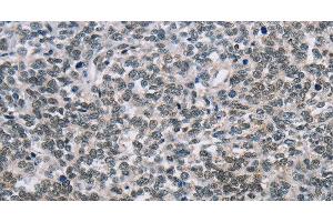 Immunohistochemistry of paraffin-embedded Human ovarian cancer tissue using TONSL Polyclonal Antibody at dilution 1:60 (NFKBIL2 抗体)