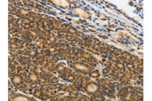 The image on the left is immunohistochemistry of paraffin-embedded Human thyroid cancer tissue using ABIN7130641(PIWIL4 Antibody) at dilution 1/25, on the right is treated with fusion protein. (PIWIL4 抗体)