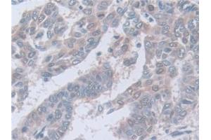 Detection of CAPNS1 in Human Liver cancer Tissue using Polyclonal Antibody to Calpain, Small Subunit 1 (CAPNS1)