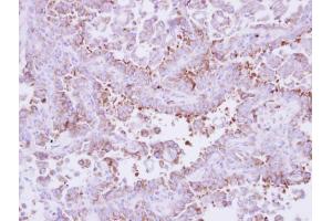 IHC-P Image Immunohistochemical analysis of paraffin-embedded human lung cancer, using Laminin beta 3, antibody at 1:250 dilution. (Laminin beta 3 抗体)