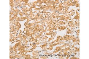 Immunohistochemistry of Human colon cancer using CD24 Polyclonal Antibody at dilution of 1:40 (CD24 抗体)
