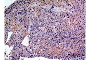 Immunohistochemistry (IHC) analysis of paraffin-embedded Human Liver Cancer, antibody was diluted at 1:100. (SCCA1/2 (Internal Region) 抗体)