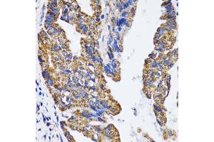 Immunohistochemistry of paraffin-embedded human gastric cancer using TP53 antibody (ABIN5973383) at dilution of 1/100 (40x lens). (p53 抗体)