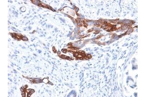 Formalin-fixed, paraffin-embedded human Gastric Carcinoma stained with MUC6 Rabbit Recombinant Monoclonal Antibody (MUC6/1553R). (Recombinant MUC6 抗体)