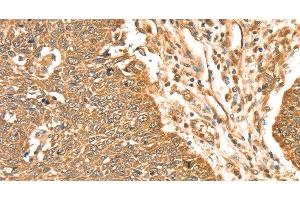 Immunohistochemistry of paraffin-embedded Human lung cancer using ERK 5 Polyclonal Antibody at dilution of 1:35 (MAPK7 抗体)