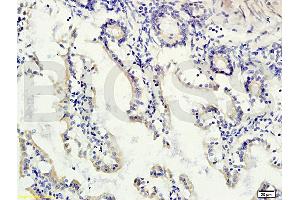Formalin-fixed and paraffin embedded human colon carcinoma labeled with Rabbit Anti-gremlin Polyclonal Antibody (ABIN687082) at 1:200 followed by conjugation to the secondary antibody and DAB staining. (GREM1 抗体  (AA 101-184))