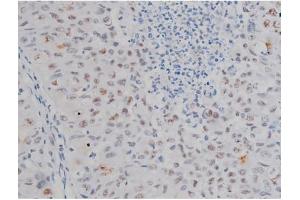 ABIN6267230 at 1/200 staining Human lung cancer tissue sections by IHC-P. (IKK-alpha /IKK-beta 抗体  (pSer180, pSer181))