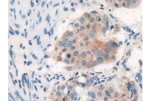 Detection of PAR4 in Human Lung cancer Tissue using Polyclonal Antibody to Protease Activated Receptor 4 (PAR4) (F2RL3 抗体  (AA 48-385))