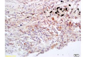 Formalin-fixed and paraffin embedded human lung carcinoma labeled with Rabbit Anti Jak3 Polyclonal Antibody, Unconjugated (ABIN681013) at 1:200 followed by conjugation to the secondary antibody and DAB staining (JAK3 抗体  (AA 601-700))