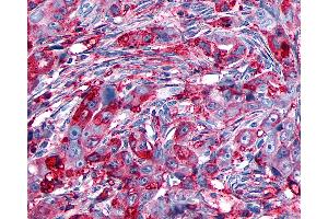 Anti-GPR133 antibody IHC of human Ovary, Carcinoma. (G Protein-Coupled Receptor 133 抗体  (Cytoplasmic Domain))
