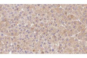 ABIN6273362 at 1/100 staining Human Melanoma tissue by IHC-P. (LDHAL6A 抗体  (Internal Region))